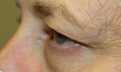 55 year old woman before blepharoplasty