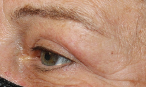 60 year old side shot after upper blepharoplasty procedure