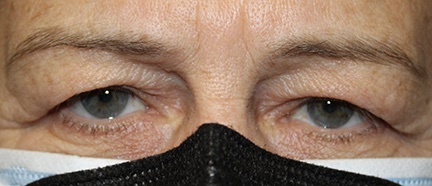 60 year old female front image before blepharoplasty surgery