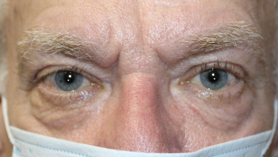 64 year old man before receiving lower blepharoplasty procedure