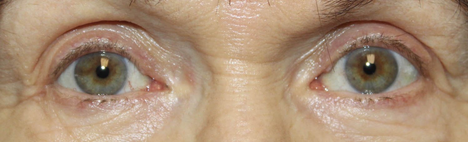 67 yera old female bilateral surgery ptosis repair