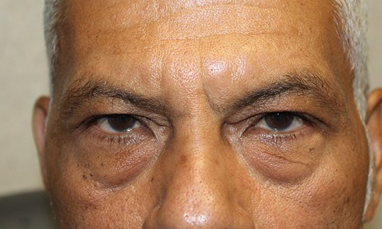 before surgery for blepharoplasty on male patient