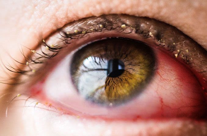 Zoom in of an eye ball that is red in the corner