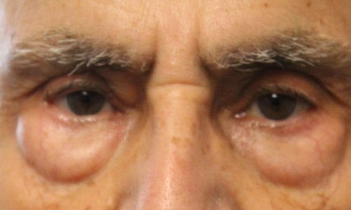 man before lower blepharoplasty