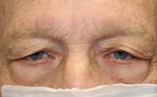 male before blepharoplasty surgery