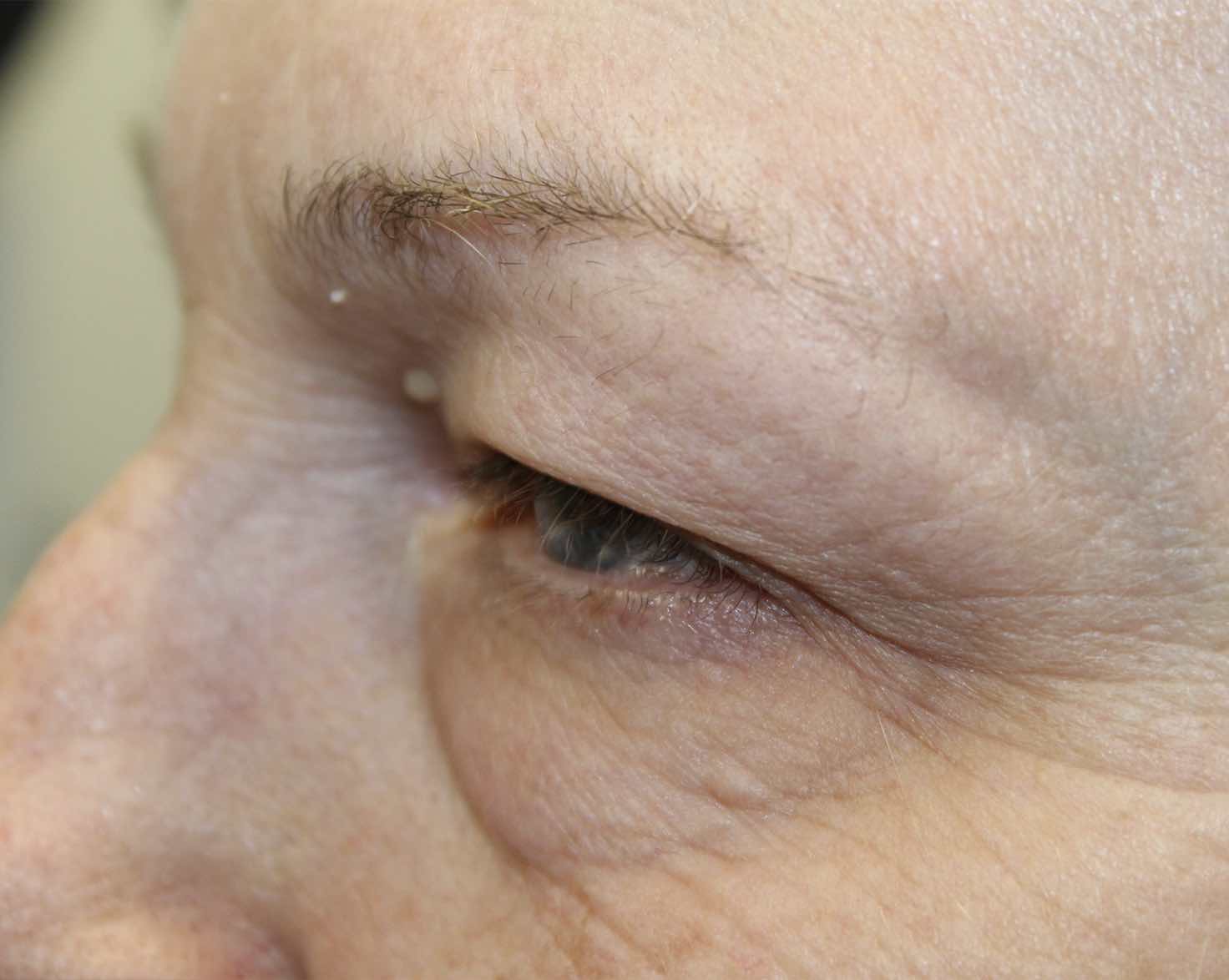 65 year old woman before upper eyelid blepharoplasty procedure