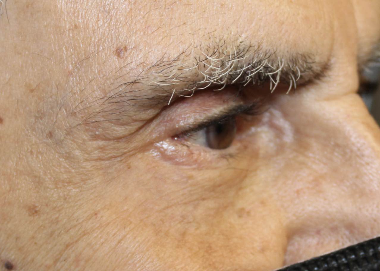 male patient lower blepharoplasty procedure