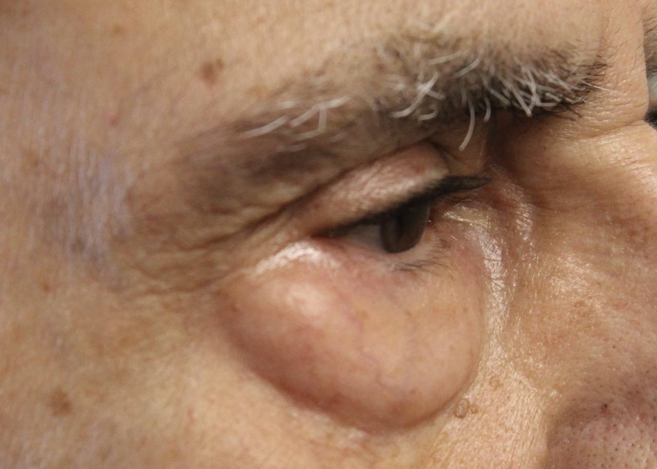 before lower blepharoplasty procedure male