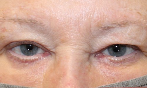 woman before upper blepharoplasty procedure