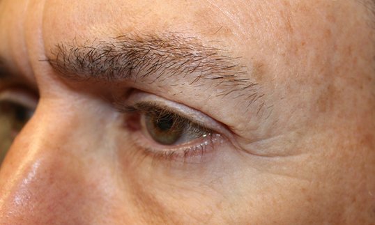 patient results after blepharoplasty procedure