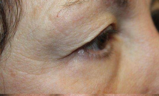 female side view before upper blepharoplasty