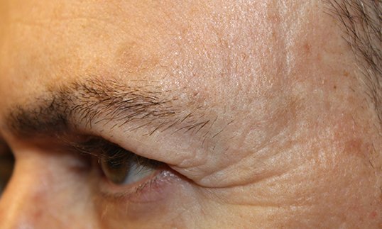 upper blepharoplasty right eye before