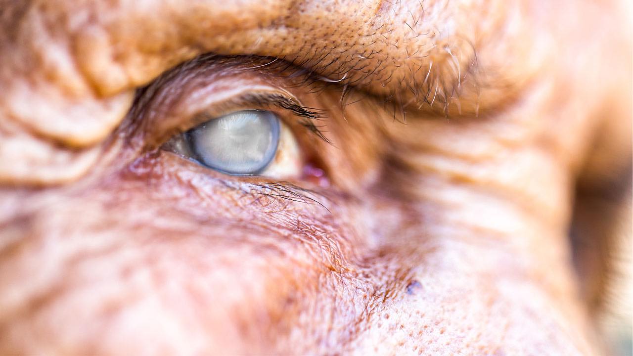 older mans eye with a cataract