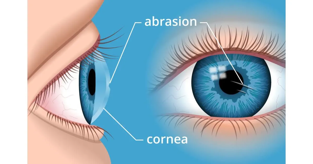 example of corneal abrasion