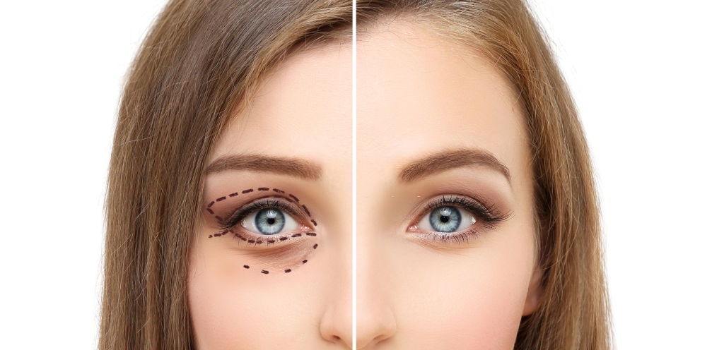 Showing side by side of a girl's eye before and after