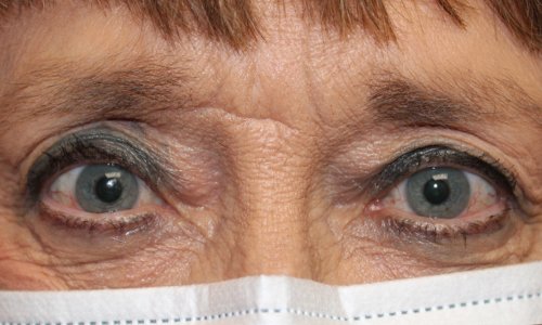 results of ptosis repair on both eyes of female patient