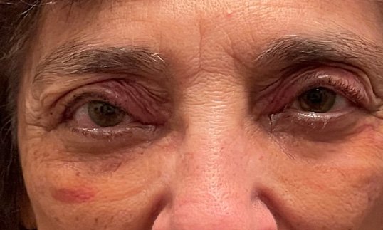 female eyes after ptosis repair