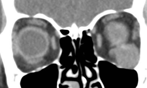 x-ray scan before orbital tumor removal