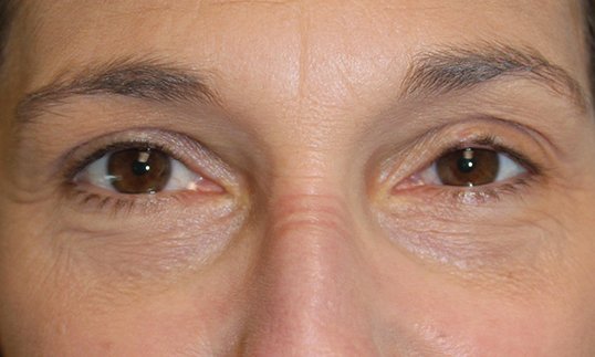 before ptosis surgery on female patient